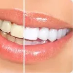 Заказать Ultradent Opalescence 10%, 15%, 20%, 35% отбеливающий гель из