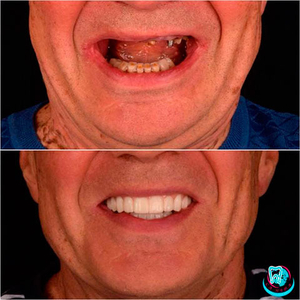 Професійна імплантація зубів у Києві - Са-Ната