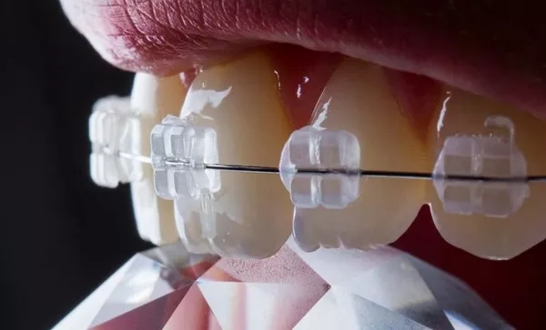 Керамические брекеты 4900 грн.