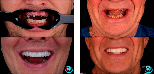 Професійна імплантація зубів у Києві - Са-Ната