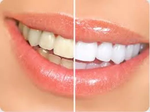Заказать Ultradent Opalescence 10%, 15%, 20%, 35% отбеливающий гель из
