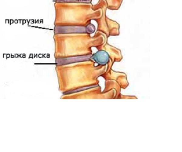 Исцеление от сколиоза,  лордоза,  кифоза,  межпозвоночных грыж без упражн 5